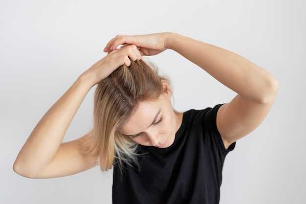 Алоpecia areata: из-за какой аутоиммунной болезни начинают выпадать волосы?