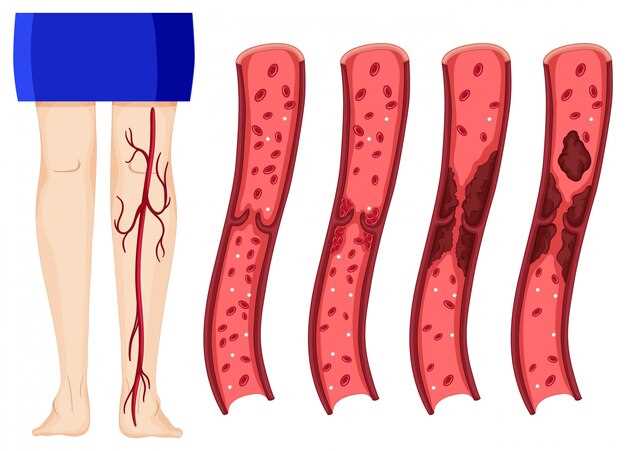 Симптомы и признаки тромбоза глубоких вен нижних конечностей