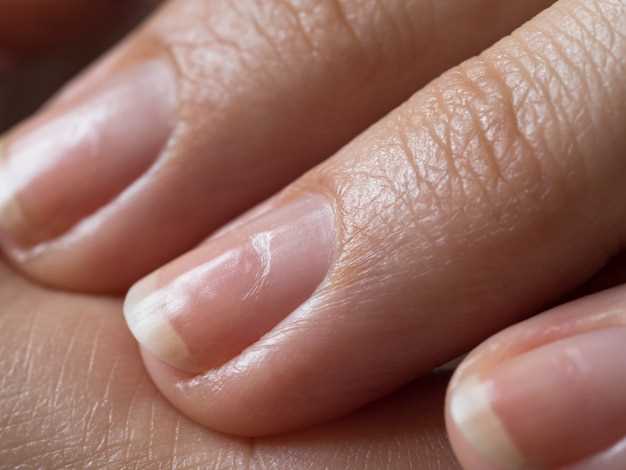 Как возникают вросшие ногти